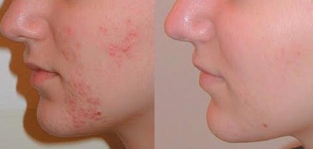 طرق فعالة لإزالة آثار حب الشباب