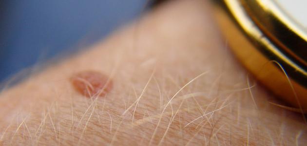 ظهور الشامات الجديدة وأسبابها