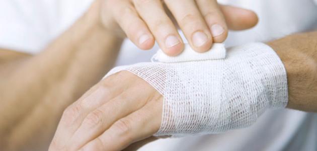 فوائد العسل في علاج الحروق