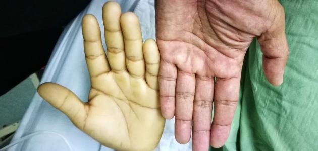 علامات فقر الدم الحاد وتأثيراته