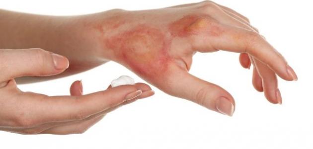 طرق فعالة للتخلص من آثار الحروق