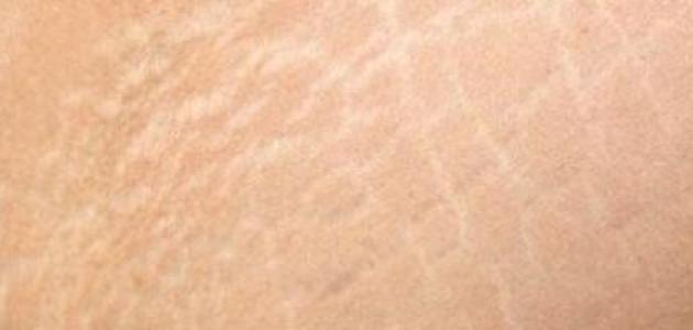 طرق فعّالة لإزالة الخطوط البيضاء من الجسم