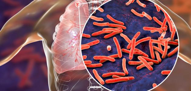 تشخيص مرض السل: الطرق والإجراءات