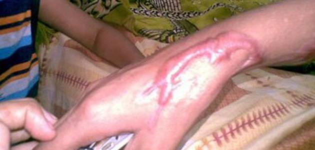 طرق فعالة لإزالة آثار الجروح والحروق القديمة