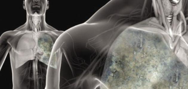 حالة الماء على الرئة: الأسباب والأنواع والعلاج