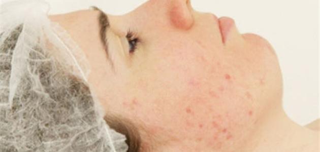 طرق فعالة لإزالة آثار الحبوب