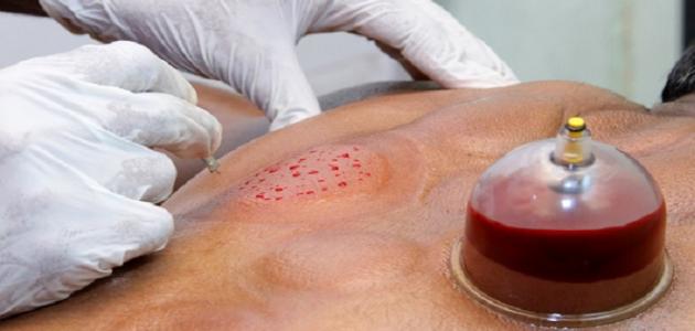 أنواع الحجامة وفوائدها العديدة