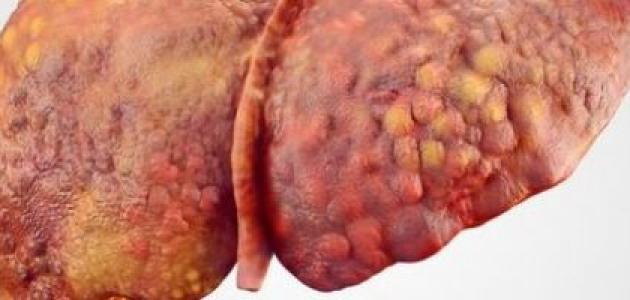 ارتفاع إنزيمات الكبد لدى الحوامل: الأسباب والوقاية