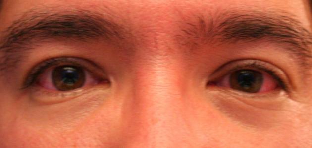 علاج الرمد الربيعي وأعراضه وأسبابه