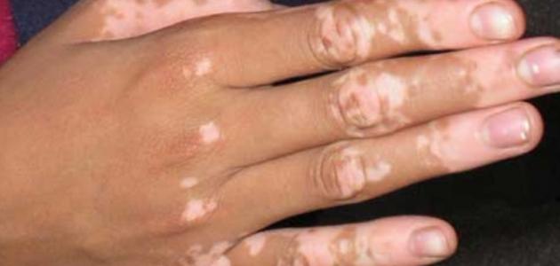 أسباب ظهور بقع بيضاء على اليدين وطرق علاجها