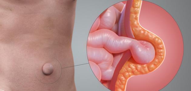 تعريف الفتق وأنواعه وأعراضه