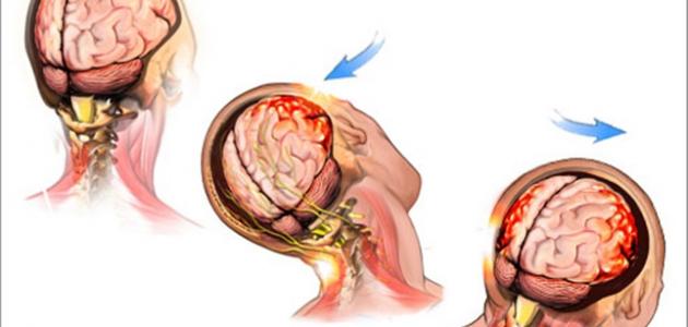 أسباب اهتزاز الرأس وطرق التعامل معه