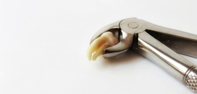 أعراض التهاب ضرس العقل بعد الخلع وكيفية التعامل معها