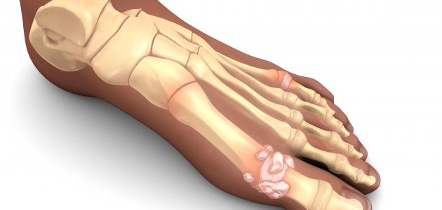 أسباب وعلاج ألم مشط القدم