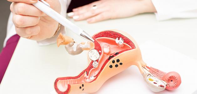 أعراض التصاقات الرحم وأسبابها وطرق العلاج