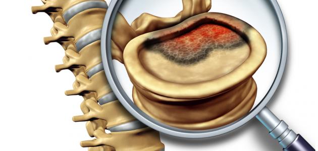 تشخيص سرطان العظام: الفحوصات والتحاليل اللازمة