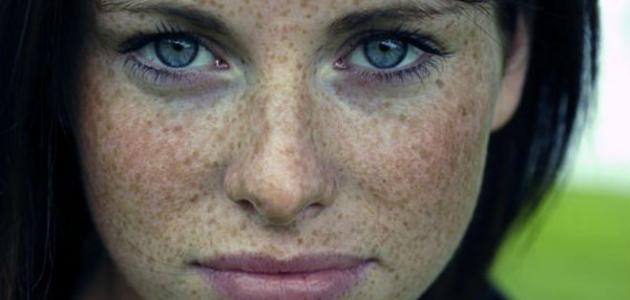 طرق علاج النمش ووقايته