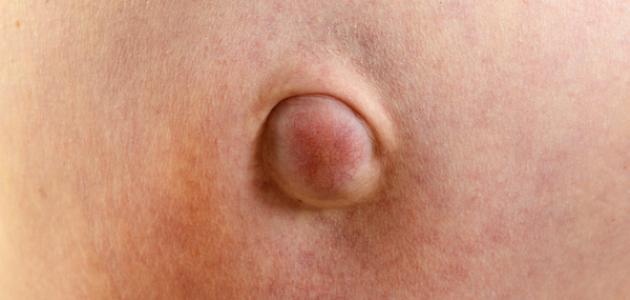 الفتق السري: الأسباب والعلاج
