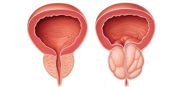 الاختلافات بين تضخم البروستاتا الحميد والخبيث
