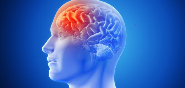 التصلب اللويحي: تعريفه وأعراضه وأسبابه وعلاجه