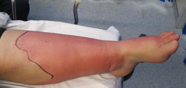 التهابات بكتيرية جلدية: أنواعها وأعراضها