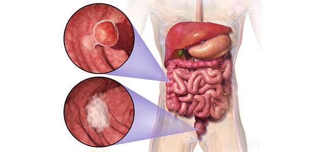 أعراض وعلاج أورام المستقيم: فهم شامل