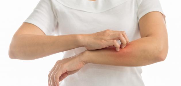 حكة الجلد: الأسباب والتشخيص