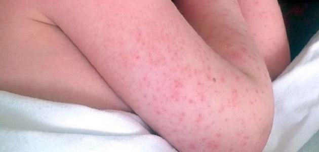 أسباب ظهور حبوب حمراء على جلد الأطفال وطرق العلاج