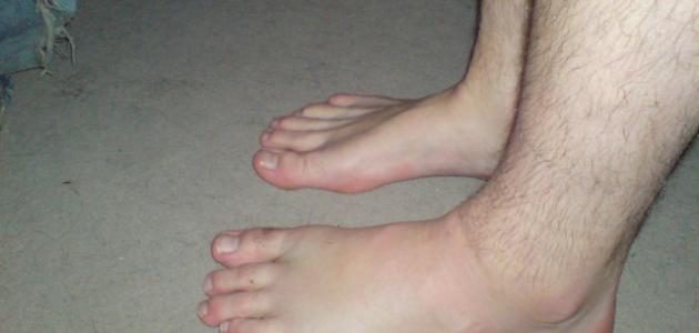 أسباب احتباس السوائل في الجسم وأثرها على الصحة