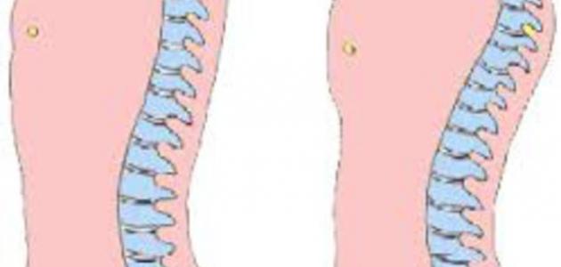 تمارين فعالة لتقويم انحناء العمود الفقري