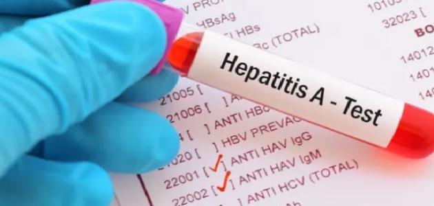 أسباب فيروس الكبد وأعراضه وطرق انتقاله