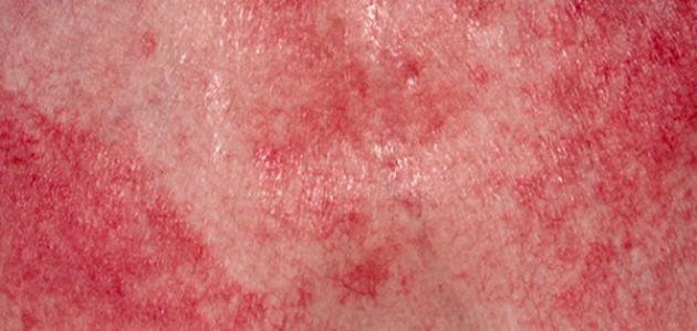 أعراض التهاب الجلد والعضلات