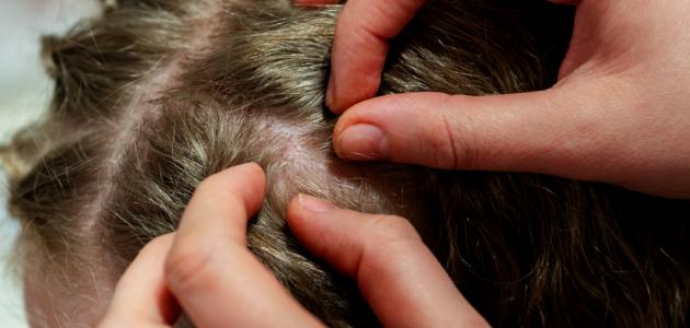 طرق فعالة للتخلص من القمل وبيضه