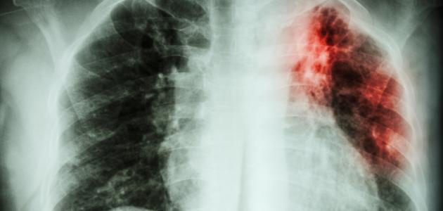 أسباب تليف الرئة