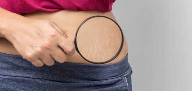 أسباب ظهور الخطوط الحمراء على الجلد