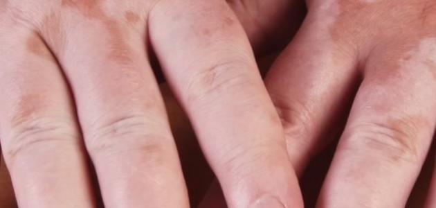 أسباب وطرق علاج ظهور بقع فاتحة على الجلد