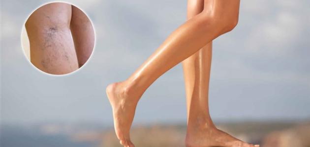 دوالي الساقين: الأسباب والأعراض وطرق الوقاية