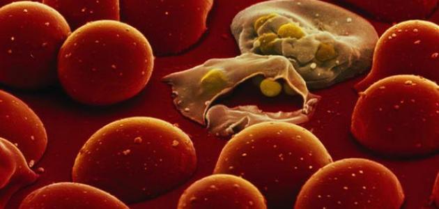 تسمم الدم: الأسباب، الأعراض، وطرق العلاج