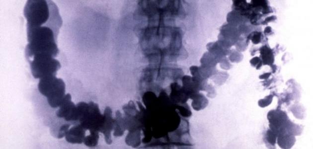 تضخم القولون: الأسباب والأعراض والعلاج