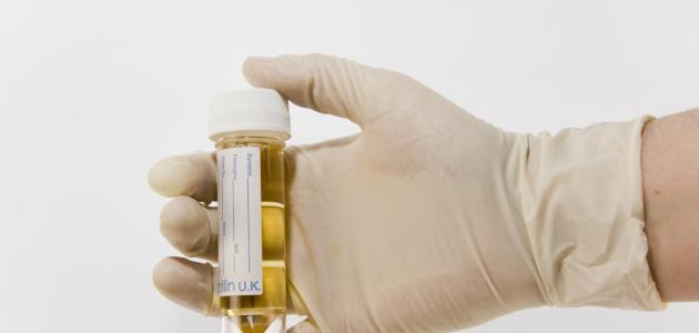 ارتفاع زلال البول: الأسباب والأعراض وطرق العلاج الطبيعية