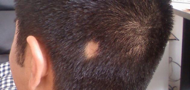 أمراض فروة الرأس وتأثيرها على صحة الشعر