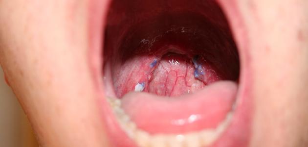 سرطان الحنجرة: الأعراض، عوامل الخطر ومعدلات البقاء