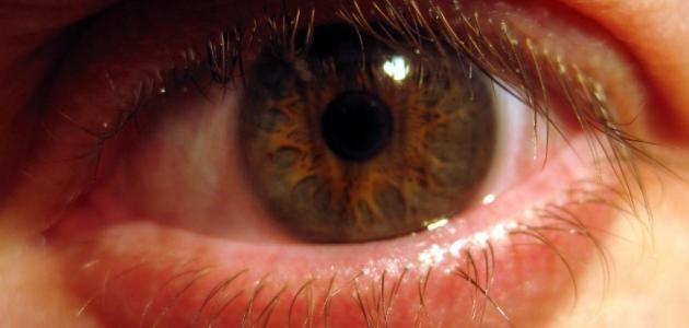 أسباب رمد العين وأنواعه