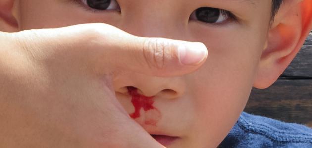 طرق علاج نزيف الأنف عند الأطفال