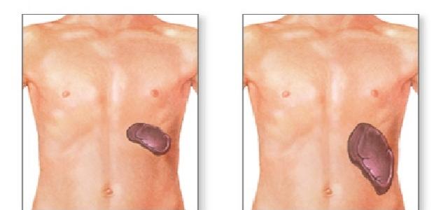 أسباب تضخم الكبد وأعراضه