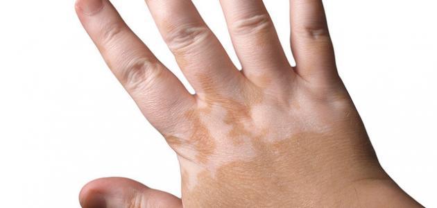 طرق طبيعية لعلاج البهاق