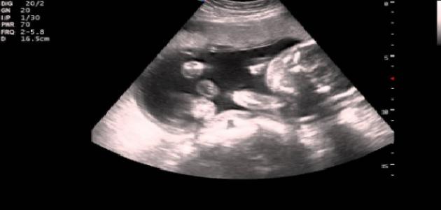 تشخيص الأمراض الوراثية عند الجنين أثناء الحمل