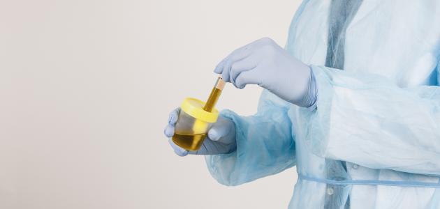 الحرقان في مجرى البول: الأسباب والعلاج