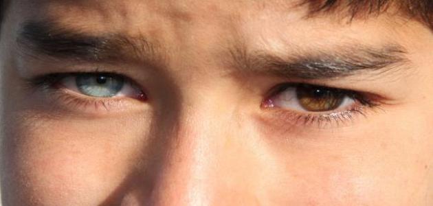 العيوب الخلقية للعين: أنواعها وأسبابها