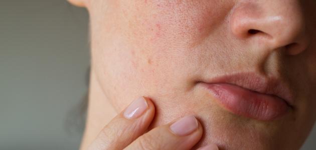 طرق فعالة لعلاج مسامات الوجه الواسعة